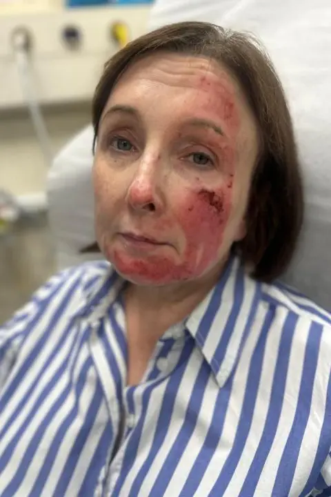 Nick Palit Woman with facial burns lying on hospital bed